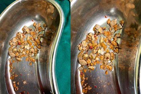 300 kidney stones removed from 75-yr-old farmer at Hyderabad's AINU - Vimarsana News