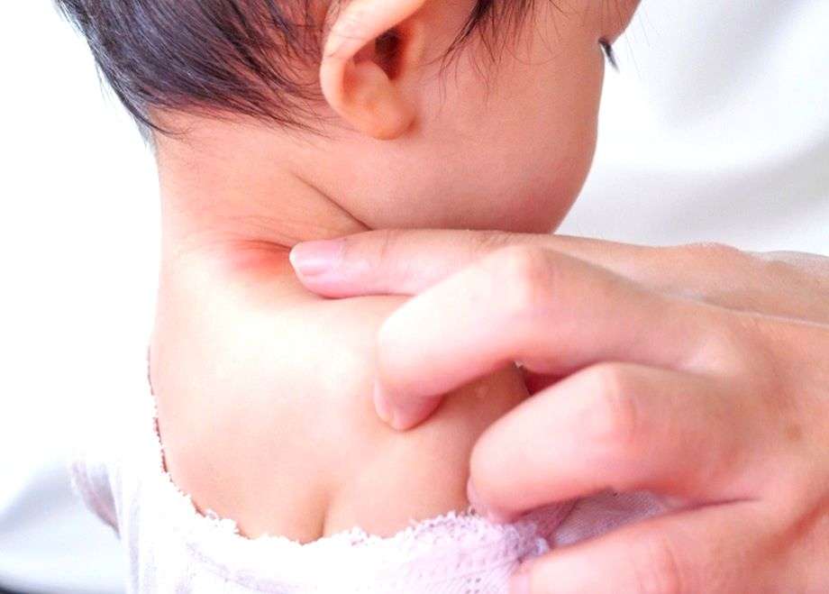 5 ways to manage childhood allergies - Vimarsana News