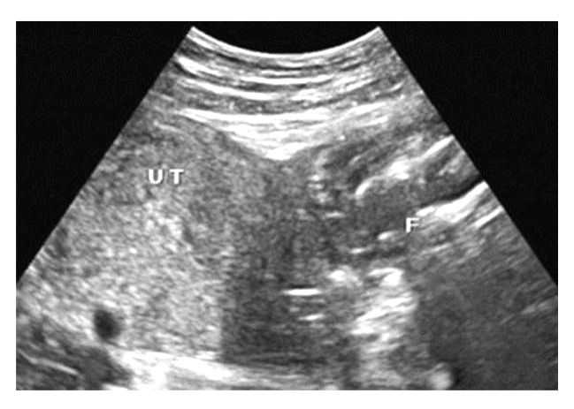 BMC hospital saves mother with ruptured uterus having dead baby - Vimarsana News