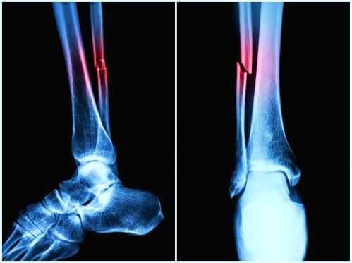 Can AI help patients with bone fractures? - Vimarsana News
