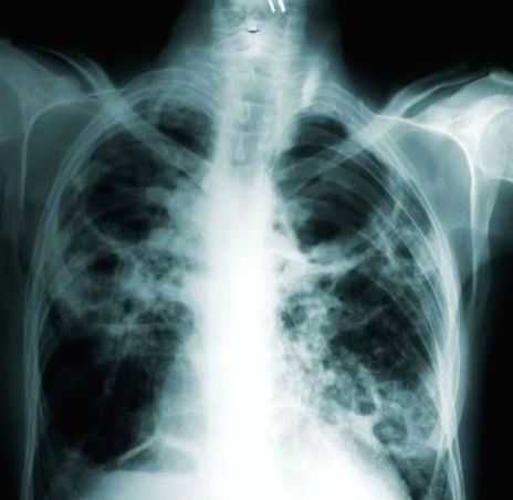 Researchers create 'Covid computer' to speed up diagnosis - Vimarsana News