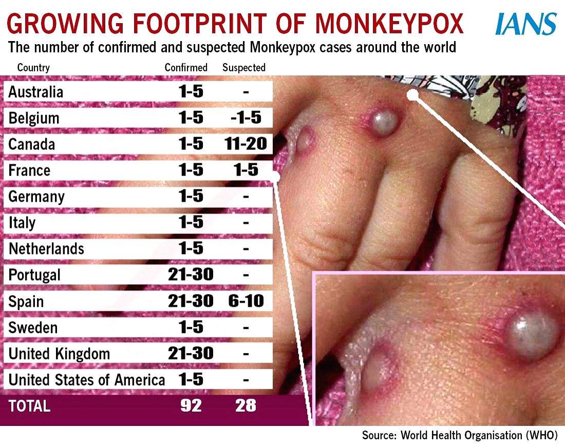 Experts warn of unusual monkeypox outbreak in Aus - Vimarsana News