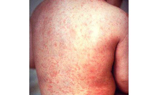 Measles cases rising again globally: Report - Vimarsana News