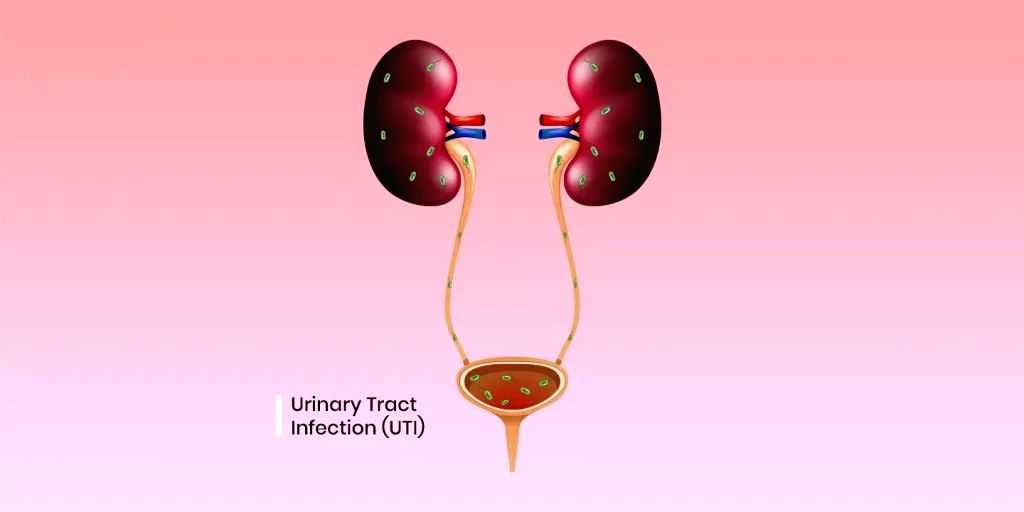 Study shows how E. coli causes urinary tract infections - Vimarsana News
