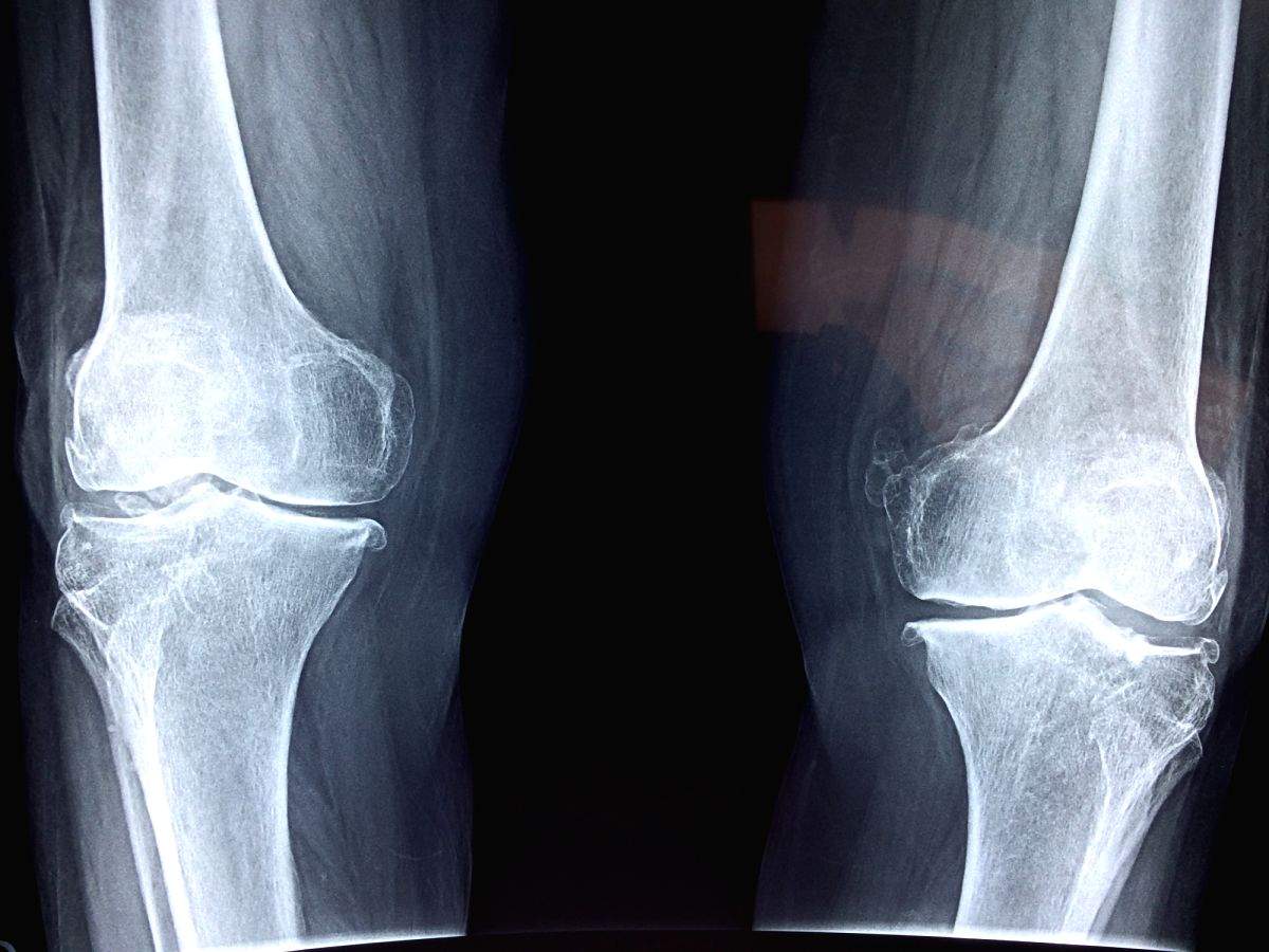 Octagenarian undergoes successful total knee replacement surgery - Vimarsana News