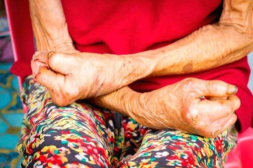 WHO Goodwill Ambassador calls for renewed focus on Leprosy through 'Don't Forget Leprosy' campaign - Vimarsana News