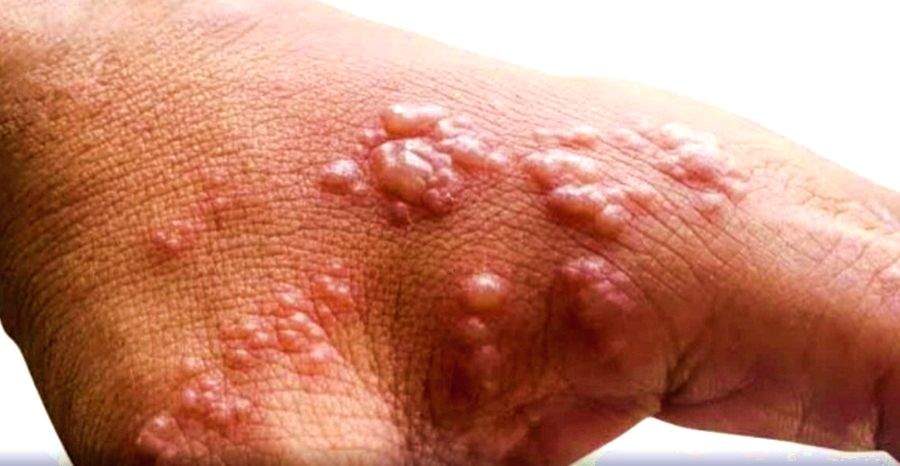 Monkeypox outbreak slowing in US, officials urge caution - Vimarsana News