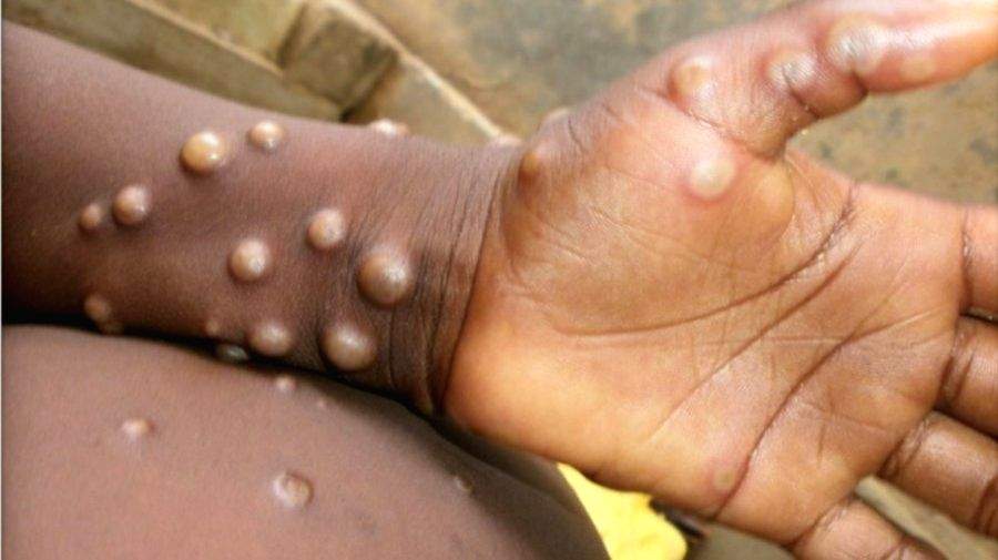 Is waning smallpox vax protection behind Monkeypox outbreak? - Vimarsana News