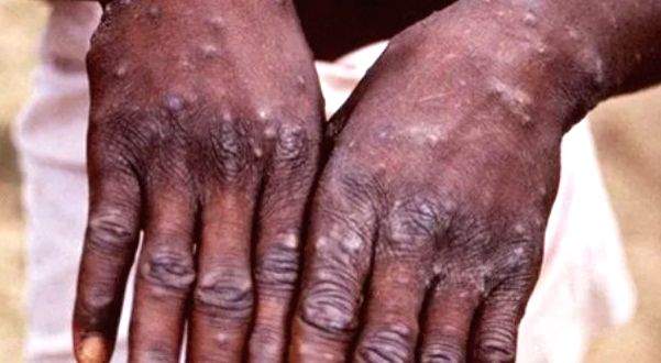 Monkeypox mutated rapidly than thought: Study - Vimarsana News