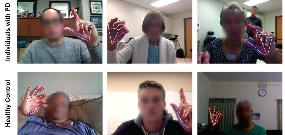 Online AI-based test for Parkinson's severity shows promising results - Vimarsana News