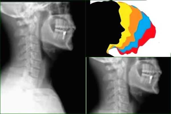 Rising 'text-neck syndrome' accounts for 70% OPD visits: Doctors - Vimarsana News