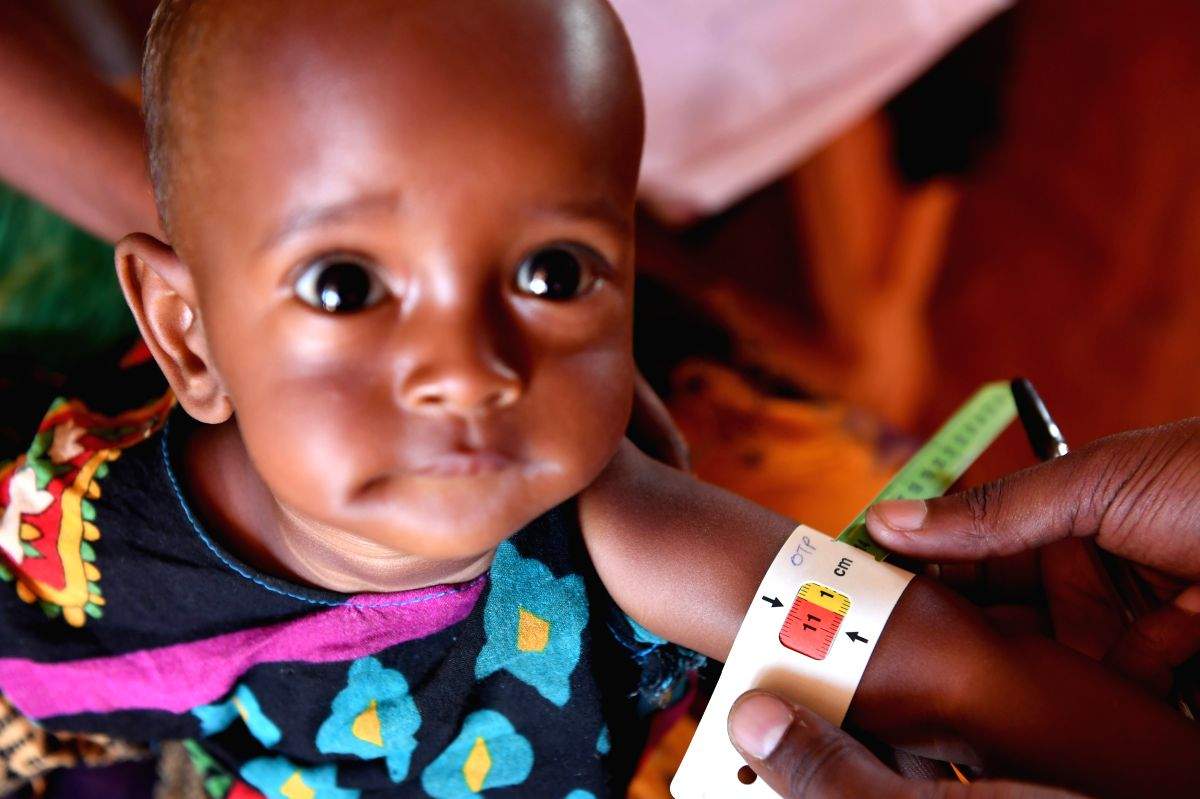 South Sudan declares measles outbreak - Vimarsana News
