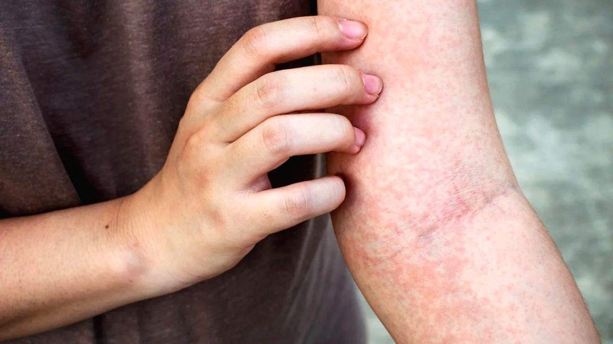 Study finds common microbe that causes persistent itching - Vimarsana News