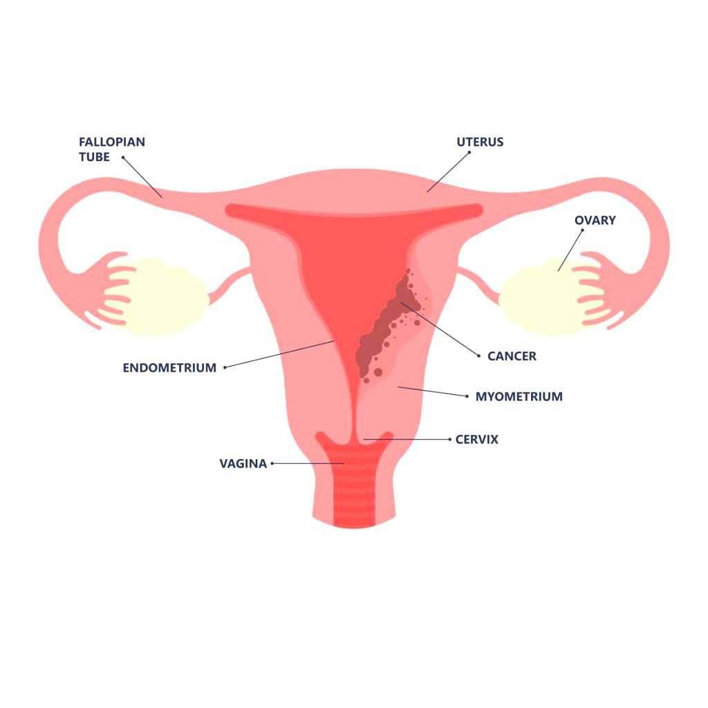 Testosterone shows promise to treat endometrial cancer: Study - Vimarsana News
