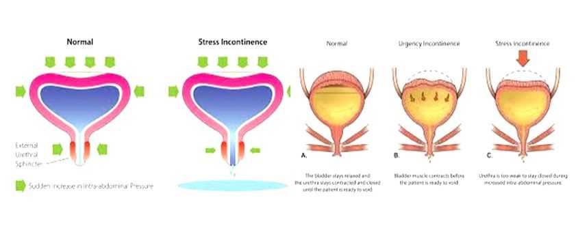 Urinary Incontinence - Vimarsana News