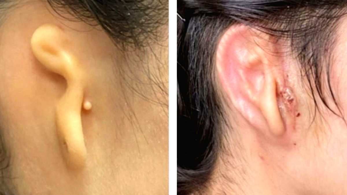 Woman implanted with 3D-printed ear made from her own cells - Vimarsana News