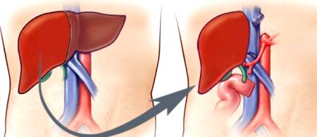 59-yr-old gets new life with liver transplant from a brain-dead donor - Vimarsana News