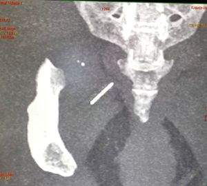 Doctors extract needle embedded deep for 3 years in hip muscle of woman - Vimarsana News