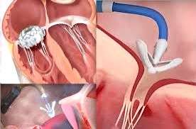 Doctors treat woman's heart disease using minimally invasive transcatheter clips - Vimarsana News