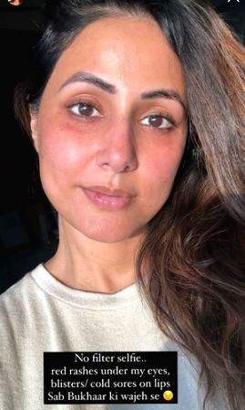 Hina Khan shares raw no-filter selfie with red rashes, blisters on lips - Vimarsana News