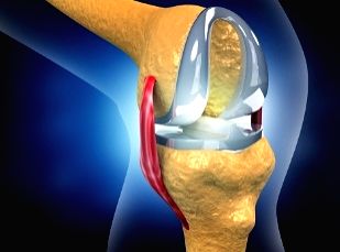 Indian scientists develop models to help improve hip, knee implants - Vimarsana News
