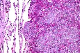 Mumbai docs successfully treat woman with rare Ewing's sarcoma of breast - Vimarsana News