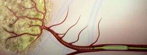 New minimally invasive therapy shows promise for liver cancer patients - Vimarsana News