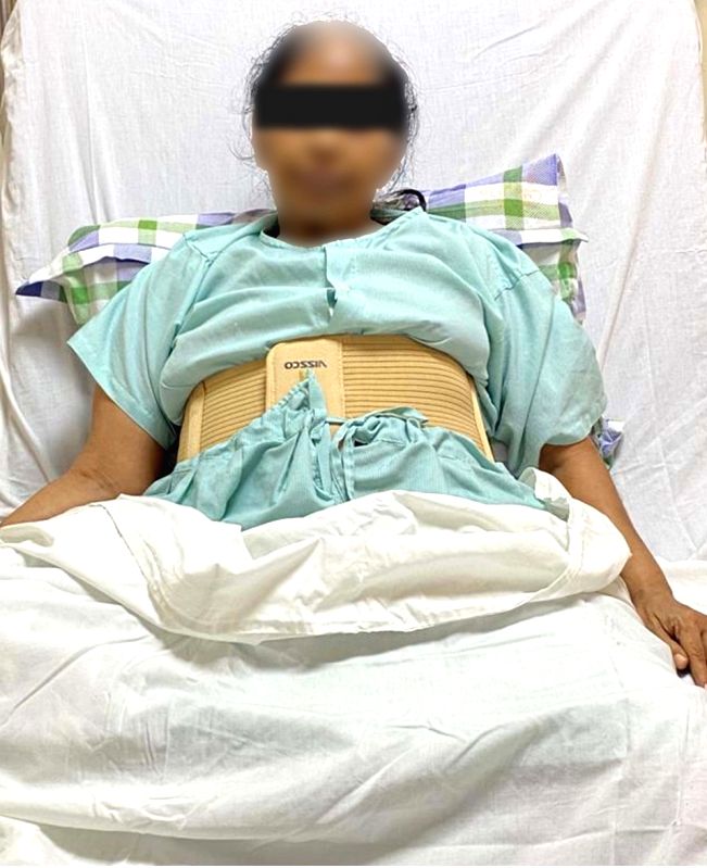 47-kg tumour removed from woman's abdomen - Vimarsana News