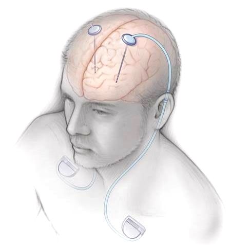Delhi doctors implant pacemaker inside brain to control Parkinson's disease - Vimarsana News