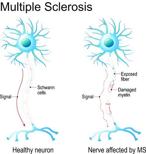 New stem cell therapy may halt multiple sclerosis progression - Vimarsana News