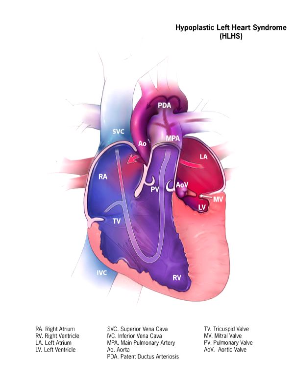 Study finds new genes that may contribute to congenital heart diseases - Vimarsana News
