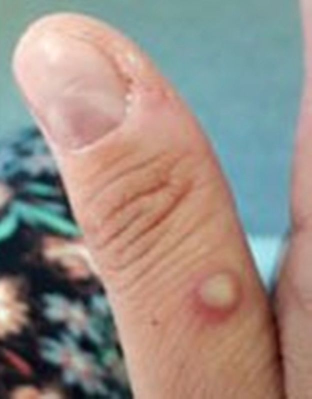 World Health Network declares monkeypox outbreak a pandemic - Vimarsana News